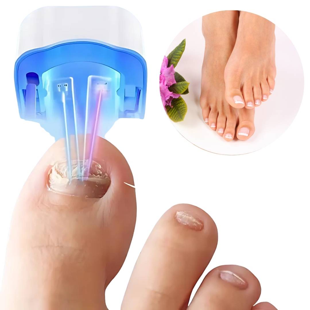 Painless and Effective Laser Treatment for Nail Fungus