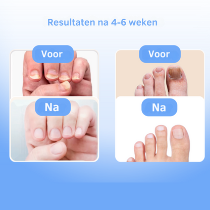 Dispositivo láser para hongos en las uñas