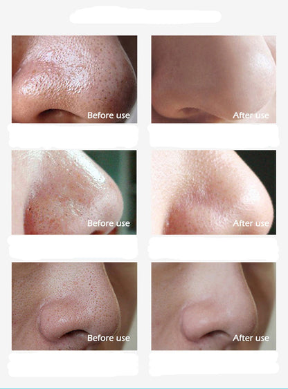 Face Formula - Blackhead Removing Nose Strips