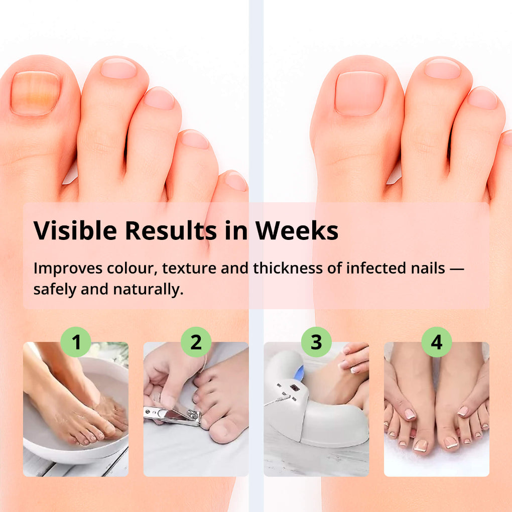 Laser Device for Nail Fungus Removal