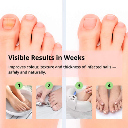 Laser Device for Nail Fungus Removal