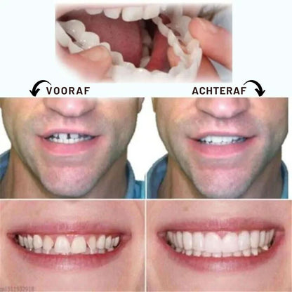 Snap-On Dentures | Adjustable